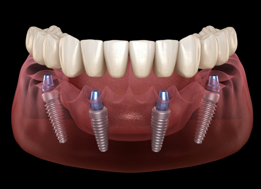 All On Four dental implants procudure